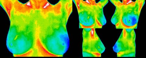 A complete normal study of the breasts