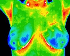 Normal thermal pattern