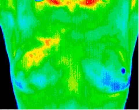Small DCIS in upper right breast