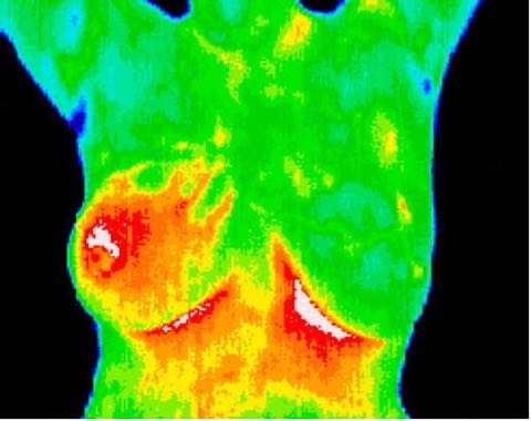 Inflammatory cancer, asymptomatic and unsuspected