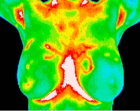 DCIS (1 of 3 of this study) medial left breast
