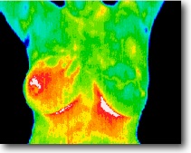 Inflammatory breast cancer