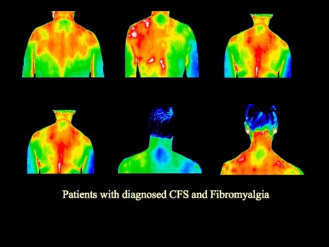 Chronic fatigue (CFS)/fibromyalgia