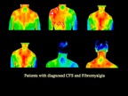 2- Chronic fatigue (CFS)/fibromyalgia.jpg