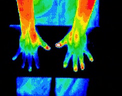 Neuropathy in fingers of right hand
