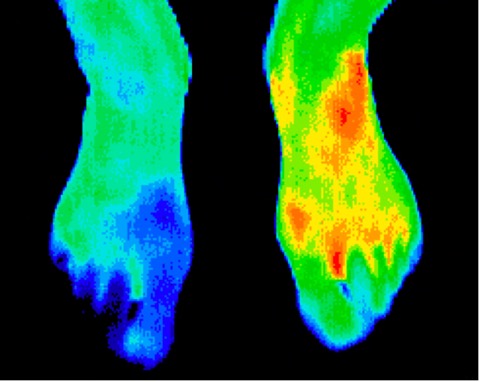 Right foot reflex sympathetic dystrophy