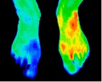 5- Right foot reflex sympathetic dystrophy.jp2
