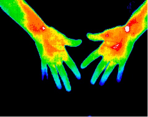 Early carpal tunnel in both hands