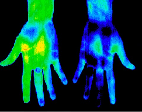 Reflex sympathetic dystrophy left hand