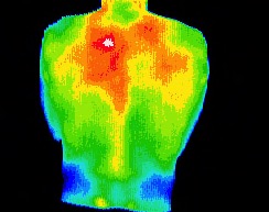 Myofascial trigger point