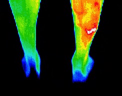 Stress fracture right ankle