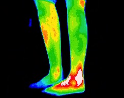 Poorly healed left ankle fracture