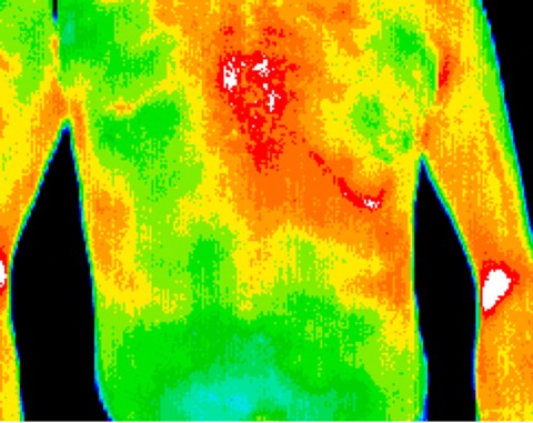 Car accident, fractured sternum