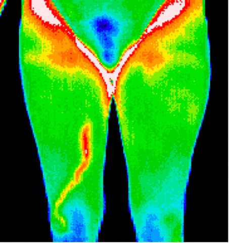 Varicosity in right leg