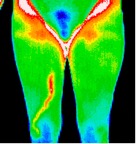 10- Varicosity in right leg.jp2