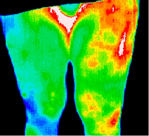 Infected hip replacement