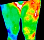 12- Infected hip replacement.jp2