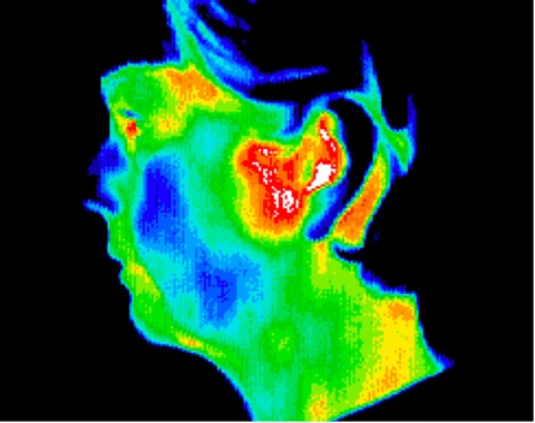 Temporomandibular joint disorder
