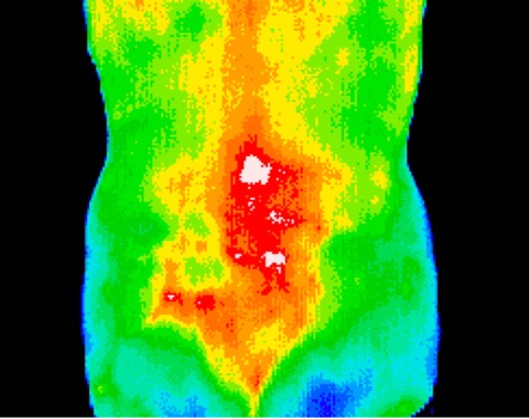 Transverse spine fractures